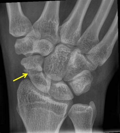 Scaphoid fracture – Radiology Cases