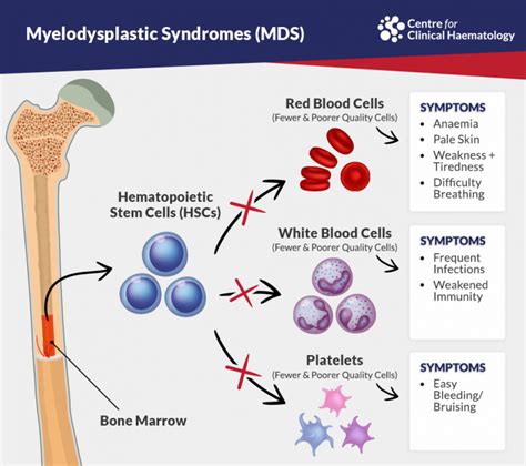 Myelodysplastic Syndromes: Signs & Treatments in Singapore