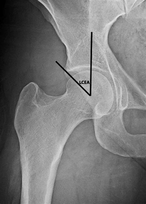 Anteroposterior radiograph demonstrating the lateral center edge angle... | Download Scientific ...