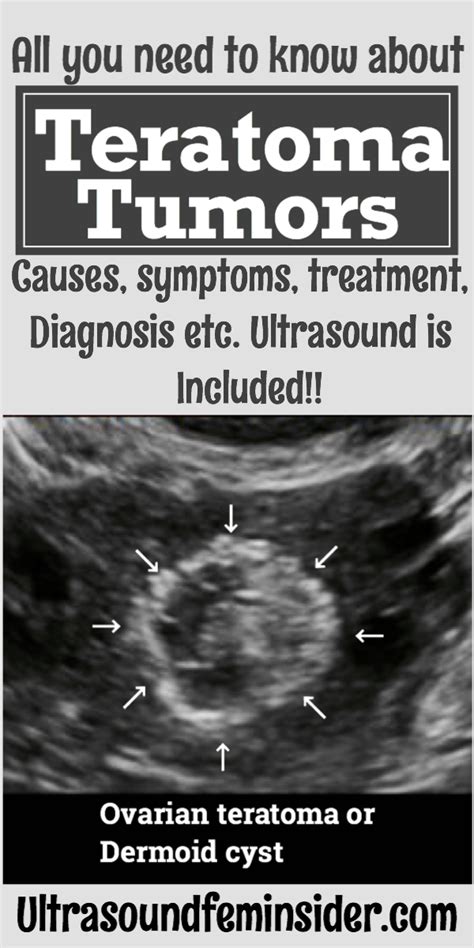 Teratoma. Causes, symptoms, diagnosis and treatment. - Ultrasoundfeminsider