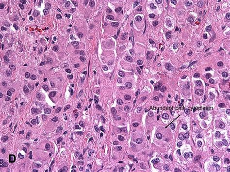 American Urological Association - Leydig Cell Tumor