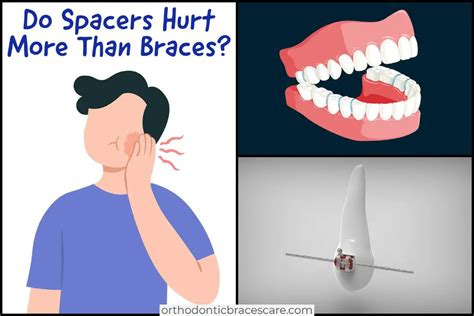 Do spacers hurt more than braces | Orthodontic Braces Care