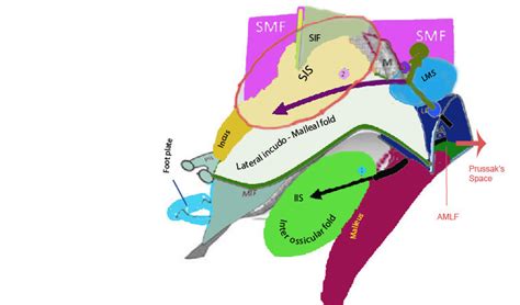 Figure showing the routes of spread of attic cholesteatoma from... | Download Scientific Diagram