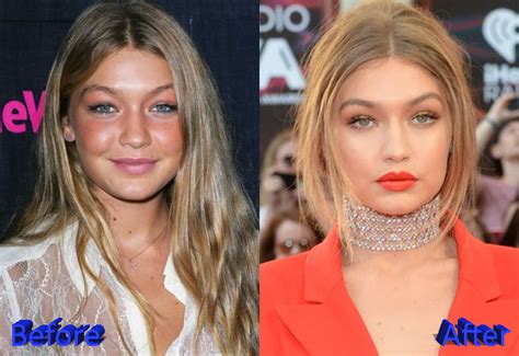 Gigi Hadid Plastic Surgery Facts and Rumors