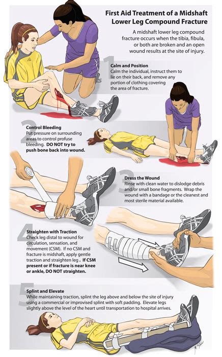 Compound Fracture First Aid – Art as Applied to Medicine