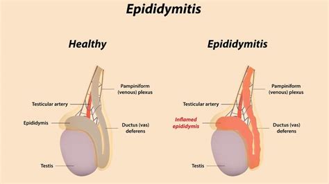 Epididymitis: Symptoms, Causes, and Long-Term Outlook | 1MD Nutrition™