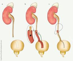 Transplant Flashcards | Quizlet