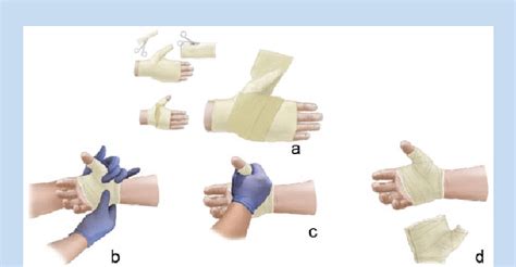 Short thumb spica cast. (a) The stockinette is pulled back to allow... | Download Scientific Diagram