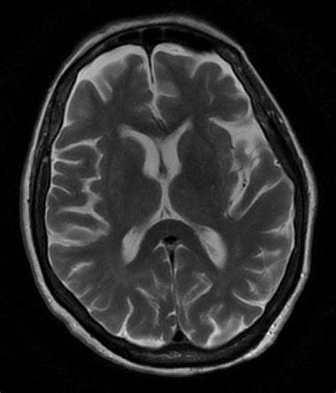 A case of large right MCA stroke with hyperdense MCA sign in CT imaging ...