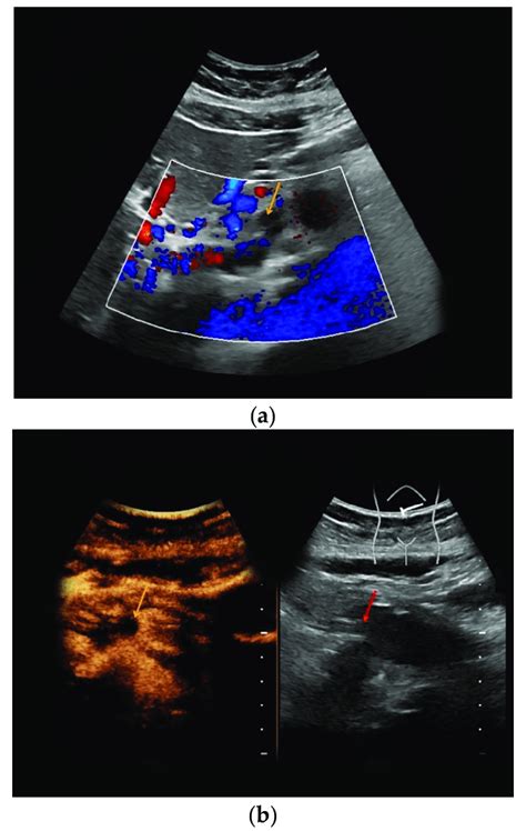 Superior Mesenteric Vein Ultrasound