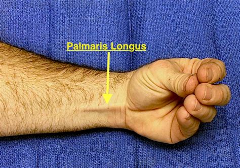 Muscle Test and Tendon Exam: Palmaris Longus | Hand Surgery Resource