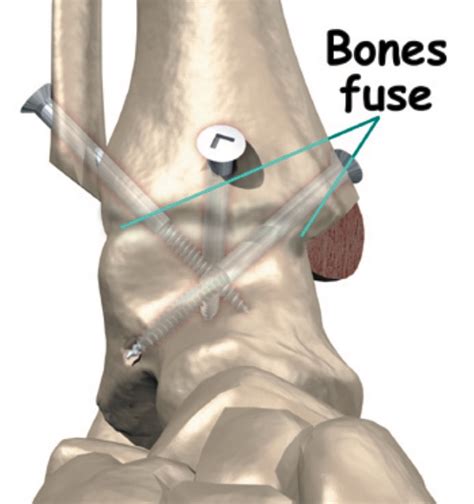 Ankle fusion surgery | Outpatient ankle fusion surgery | Seaside Surgery Center