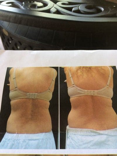 A Typical Timeline Of Recovery From Liposuction