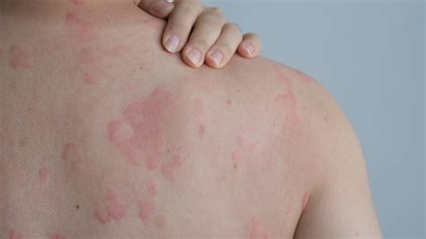 Integrative Dermatology Approach to Urticaria (Hives)