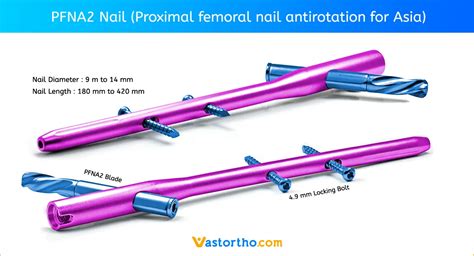 Top 101+ intertan nail surgical technique best - ceg.edu.vn