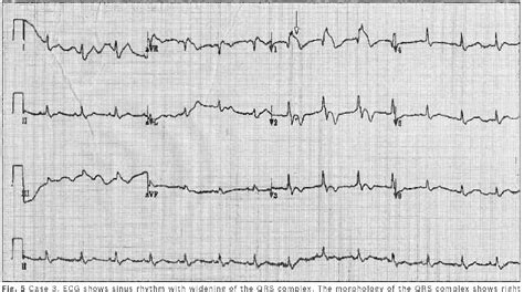 Ecg Abnormalities Examples