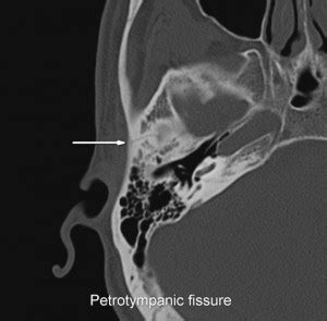 Petrotympanic fissure - Location, Function and Pictures