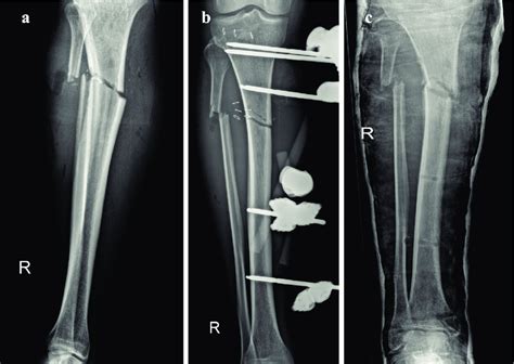 a) Only one x-ray view of the tibia was performed in E.R, showing the... | Download Scientific ...