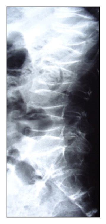 Lateral spine radiographs showing severe osteopenia, platyspondyly (a,... | Download Scientific ...