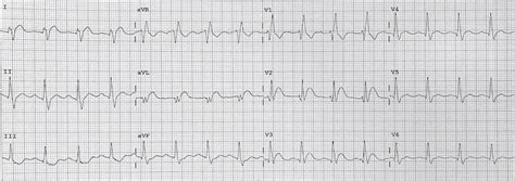 High Lateral STEMI • LITFL • ECG Library Diagnosis