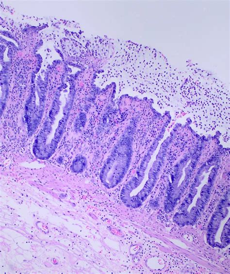 Necrotizing Enterocolitis Histology