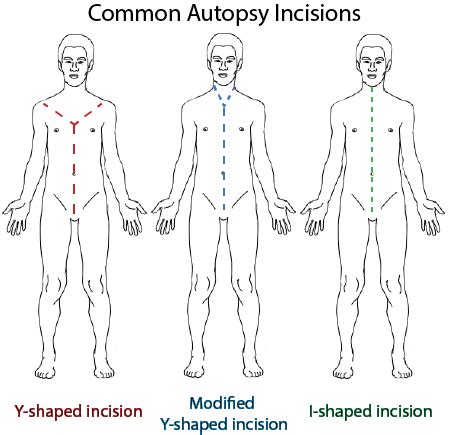 Autopsy Procedure & Results | What is an Autopsy? - Video & Lesson Transcript | Study.com