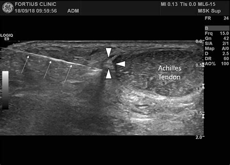 It is possible to release the plantaris tendon under ultrasound guidance: a technical ...