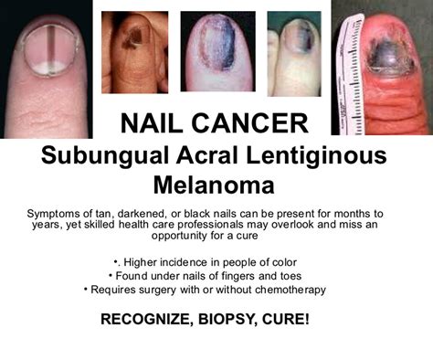 Nail Cancer: 2 Kalamazoo residents vow to raise awareness, and the survival rate, for rarely ...