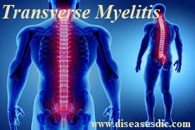 Transverse Myelitis - Causes, Complications and Treatment.