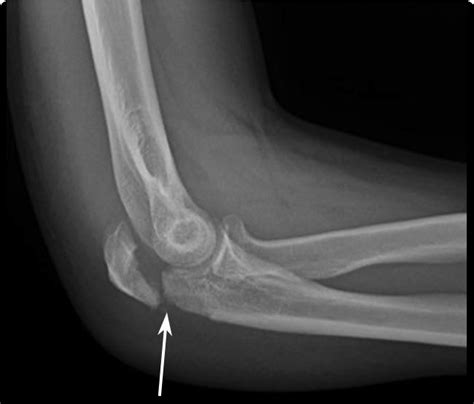 Elbow (Olecranon) Fracture | Boston Medical Center (2022)