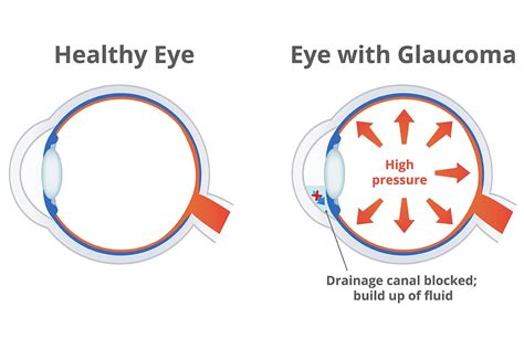 Understanding The Correlation of Glaucoma Caused by Diabetes