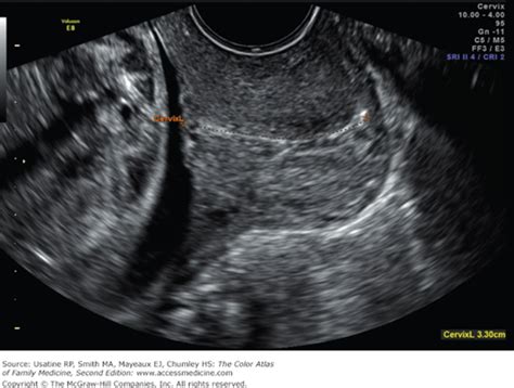 Second Trimester Obstetrical Ultrasound | Basicmedical Key