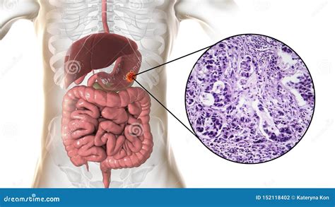 Stomach Adenocarcinoma, Gastric Cancer, Illustration and Light Micrograph Stock Illustration ...