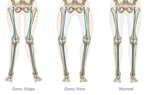 Genu Varo y Genu Valgo ¿Tus piernas están alineadas o desalineadas?