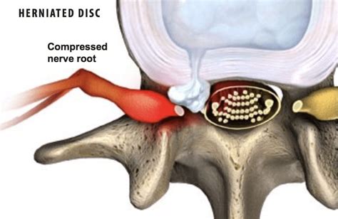 Herniated Disc Treatment - Florida Surgery Consultants