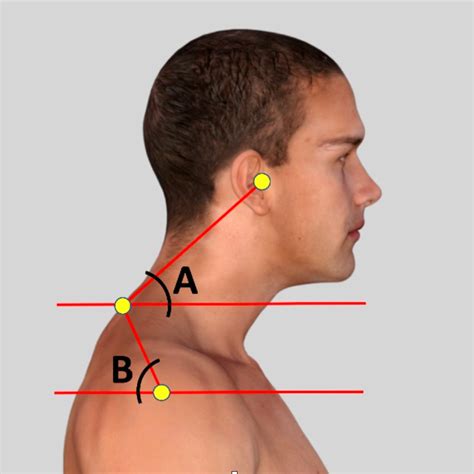 Forward Head Posture