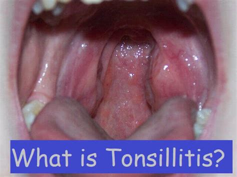What Is Tonsillitis: Causes, Symptoms, And Effective Remedies | Expert Advice Included!