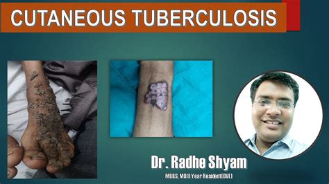 Cutaneous Tuberculosis - YouTube