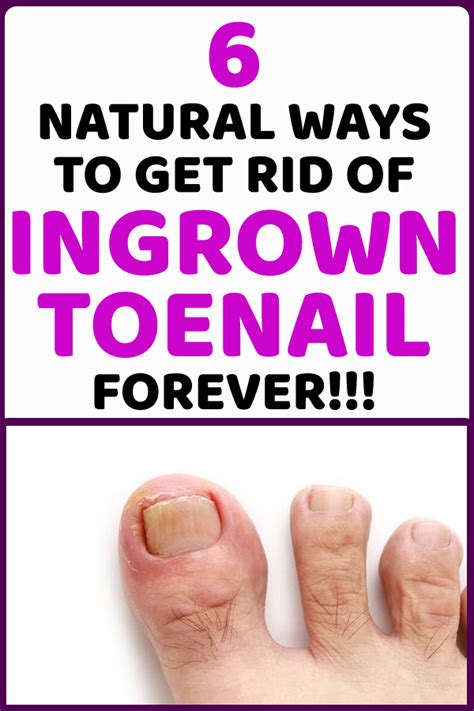 Treat Your Ingrown Toenail With These 6 Natural & Homemade Remedies