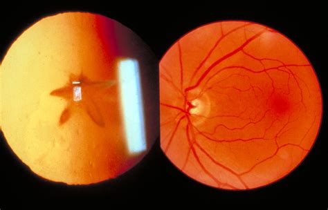 Ophthalmoscopy.Traumatic cataract (left). Normal fundus (r… | Flickr