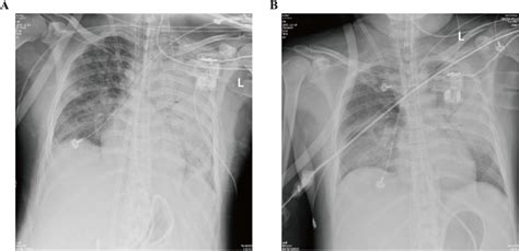 Chest X-ray scans on the abnormality in lungs during the VV-ECMO ...