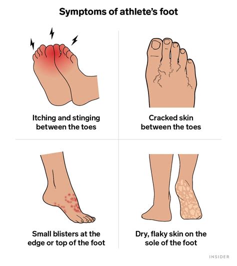 Causes And Symptoms Of Athlete's Foot - Ask The Nurse Expert