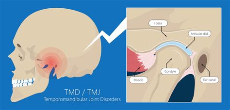 Eric Davis Dental - TMJ Dysfunction: Causes, Symptoms and TMJ Treatment