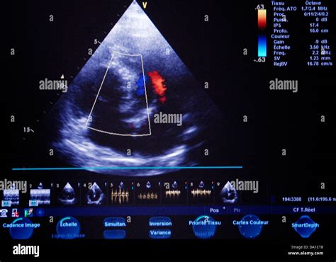 Echography heart hi-res stock photography and images - Alamy