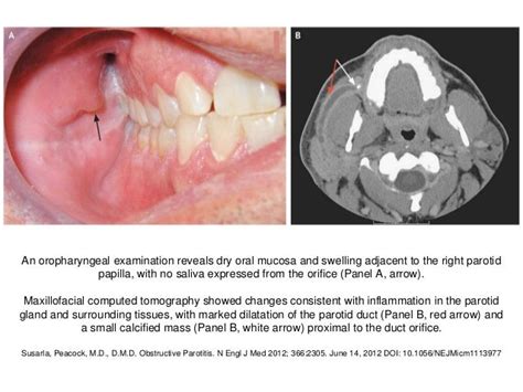 Management of Parotitis