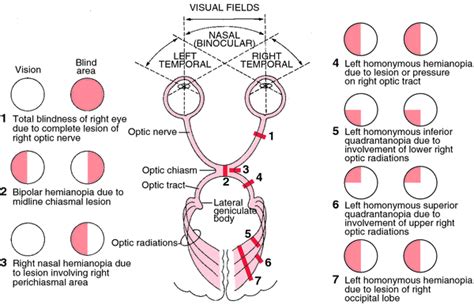 Hemianopsia | definition of hemianopsia by Medical dictionary