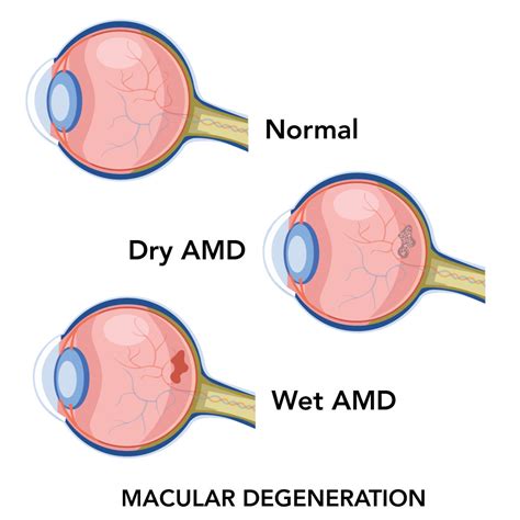 Macular Degeneration Diagnosis in Mesa | Oasis Vision Center