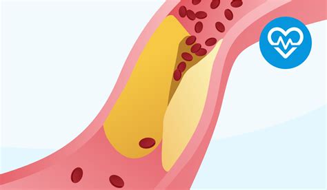 Ateroma: sintomi, cause e cure | Doctolib