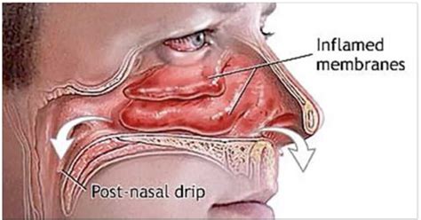 Clear Out Your Sinuses Using Only Your Fingers In a Matter of Seconds ...