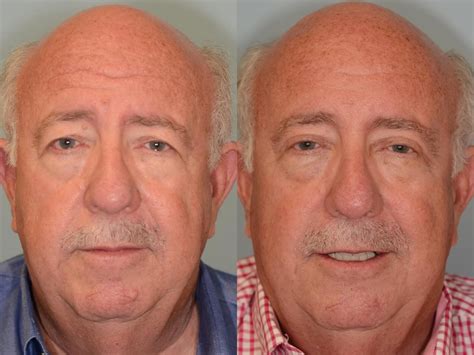 Houston Patient sought Brow lift and Upper Blepharoplasty